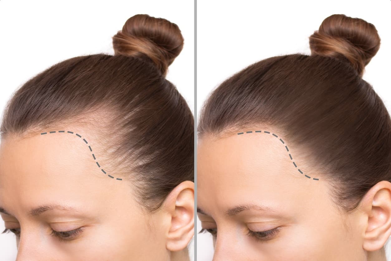 Hair Transplant London – Achieve a Younger, Fresher Look