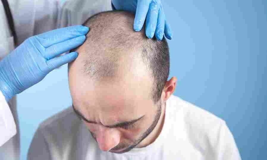 Hair Transplant Turkey: Why Thousands Choose It Every Year