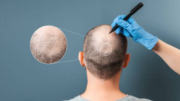 Hair Transplant Price: How Clinics Calculate Your Cost